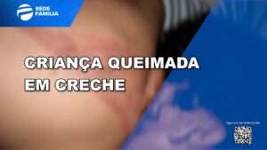 Criança de 1 ano e 9 meses sofre queimaduras em creche de Campinas